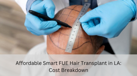 smart FUE hair transplant Los Angeles cost