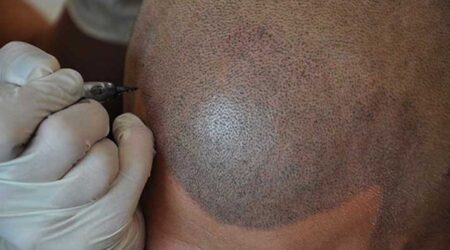 scalp micropigmentation treatment