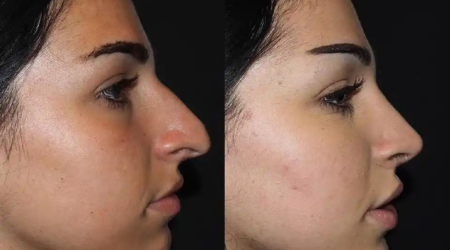 Enhancing Aesthetics: The Role of Revision Rhinoplasty in Dubai