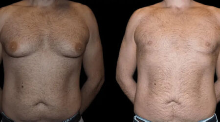 male breast reduction in dubai