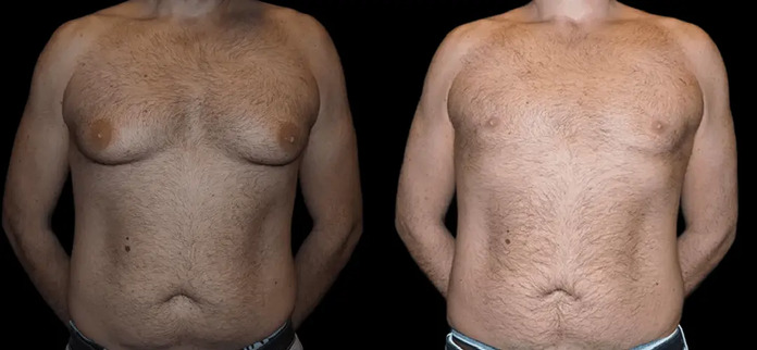 male breast reduction in dubai