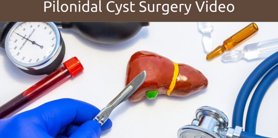 pilonidal cyst surgery video